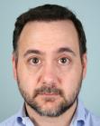 After Hair Transplant &nbsp;Front
